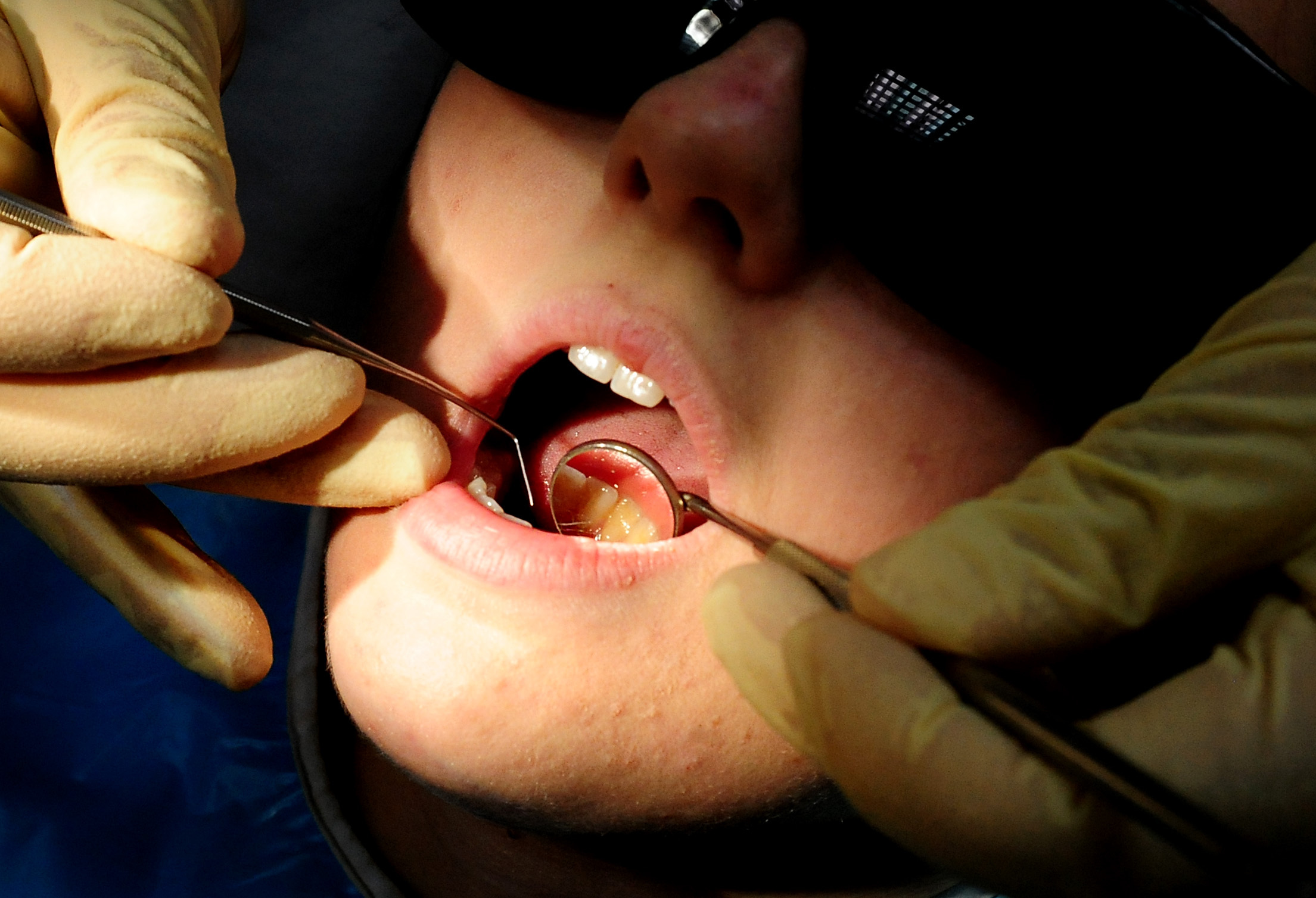 Children in South Hams have highest rate of rotting teeth in the South West