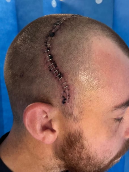 Sean's scars after brain Tumour op