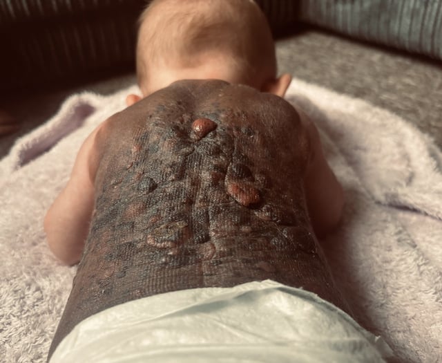 Plymouth Mum speaks out over rare birthmark